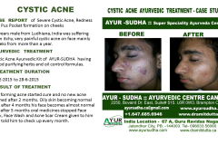 Cystic Acne Ayurvedic Natural Treatment in Brampton, Canada