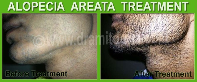 Alopecia Areata Ayurvedic Treatment In Brampton Canada