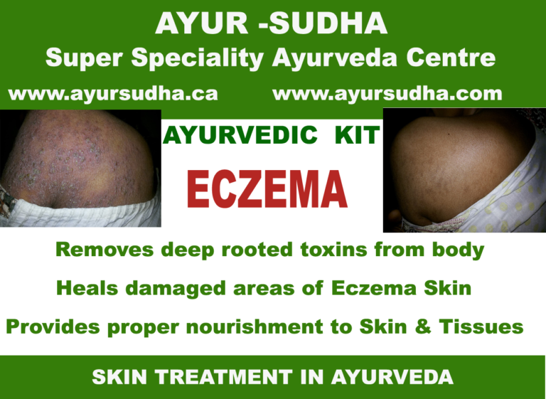 Eczema treatment in Ayurveda Best Skin Specialist Canada