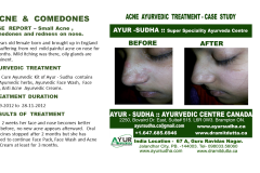 Acne in teenage Ayurvedic Treatment in Brampton, Canada