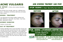 Acne Ayurvedic Treatment. Skin Clinic Canada