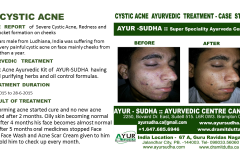 Cystic Acne Ayurvedic Natural Treatment in Brampton, Canada