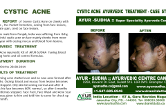 Cystic Acne Ayurvedic Natural Treatment in Brampton, Canada