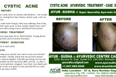 Acne Ayurvedic Natural Treatment in Brampton, Canada