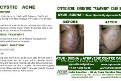 Cystic Acne Ayurvedic Natural Treatment in Brampton, Canada