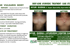 Body Acne Ayurvedic treatment Brampton, Canada