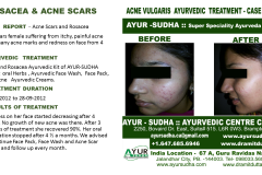 Acne Skin Ayurvedic treatment Brampton, Canada