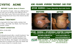 Skin treatments. Acne Vulgaris Ayurvedic Treatment Brampton