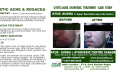 Cystic Acne Ayurvedic Natural Treatment in Canada