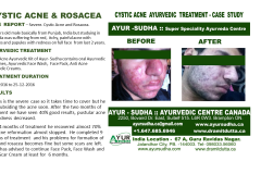 Cystic Acne Ayurvedic Natural Treatment in Canada