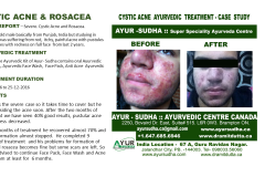 Cystic Acne Ayurvedic Natural Treatment in Canada