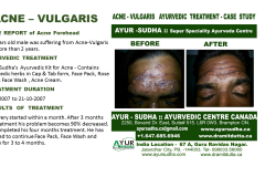 Acne Natural Ayurvedic Treatment Canada