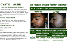 Cystic Acne Natural Ayurvedic Treatment Canada