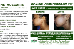 Acne Scars Ayurvedic Treatment, Brampton Canada