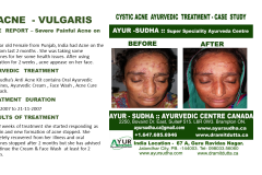 Acne Skin Ayurvedic Treatment GTA, Canada