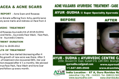 Acne Herbal Ayurvedic treatment Brampton, Canada
