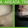 Beard Alopecia Areata