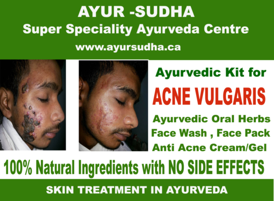 acne treatment in Canada. Best Skin Specialist