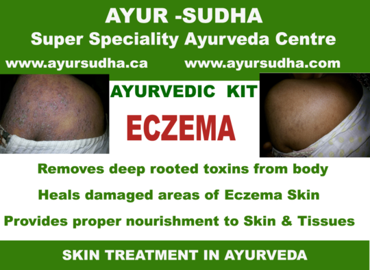 Eczema Ayurvedic treatment in Canada.